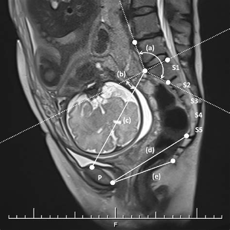 MRI pelvimetry shows the sagittal section image. Landmarks in the... | Download Scientific Diagram