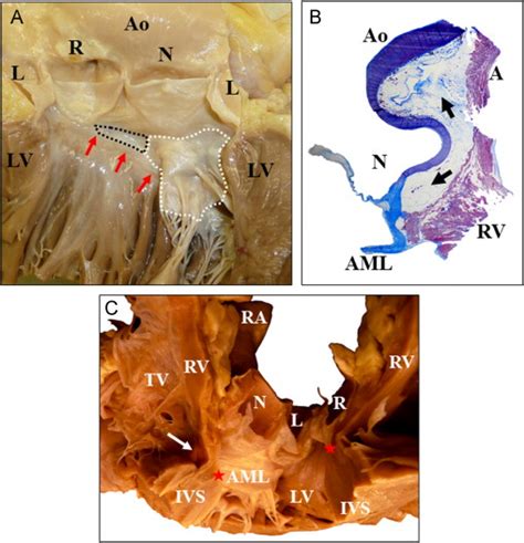 Prevalence And Clinical Electrocardiographic And Electrophysiologic