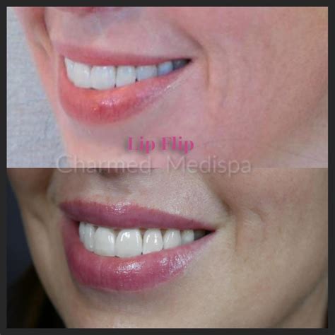 Lip Flip Versus Lip Filler Injections Charmed Medispa Delaware