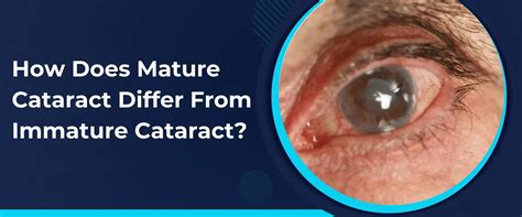Immature Vs Mature Cataracts Causes Symptoms Treatment