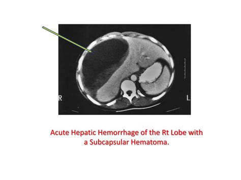 Ppt Hepatic Dysfunction During Pregnancy Powerpoint Presentation