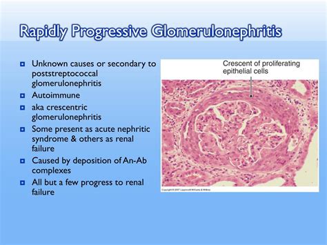 Ppt Glomerulopathies Vs Glomerulonephritis Powerpoint Presentation