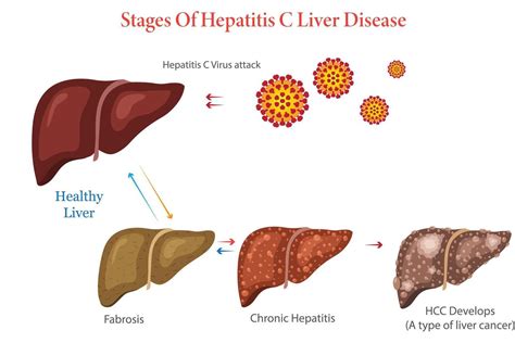 Diagram Illustration Showing Stages Of Hepatitis C Liver Disease