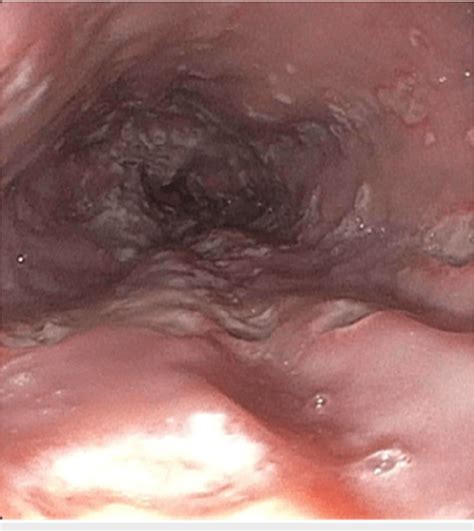 Figure 1 From Herpes Simplex Virus Esophagitis In An Immunocompetent