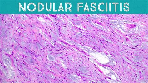 Nodular Fasciitis With Intravascular Invasion Soft Tissue Pathology Usmle Dermpath