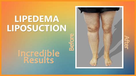 Lipedema Liposuction | Cankles & Knees | Immediate Results | Expert Dr ...