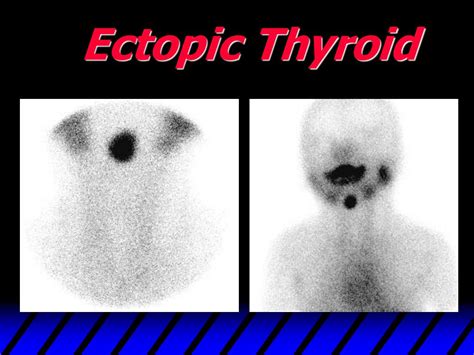 Ppt Thyroid Scan Powerpoint Presentation Free Download Id437897