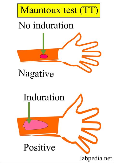 Mycobacterium Tuberculosis Part 2 Mantoux Test Tt Tuberculin Skin