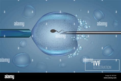 Inyección de Fertilización In Vitro La inseminación artificial Vector