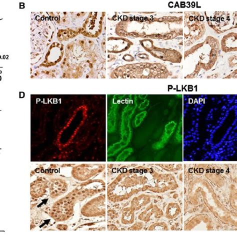 Expression Of LKB1 And Related Genes In Patients With Kidney Fi Brosis