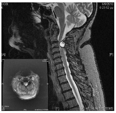 Preoperative Magnetic Resonance Imaging Mid Sagittal T2 Weighted And Download Scientific