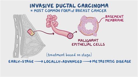 Invasive Ductal Carcinoma