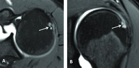 Subchondral Cyst