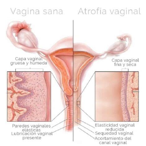 Tratamiento De La Sequedad Vaginal Con Plasma Rico En Plaquetas En