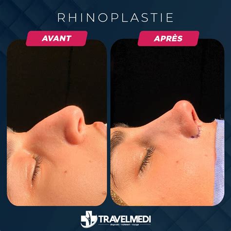 Rhinoplastie En Turquie Coût Avant Après 2024