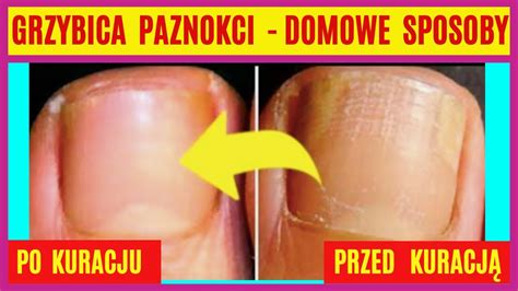 Jak Pozby Si Grzybicy Paznokci Domowymi Metodami Co Powoduje