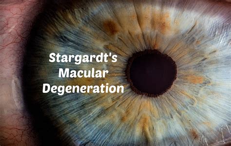 Stargardt’s Macular Degeneration Rand Eye Institute