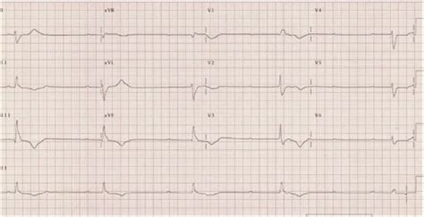 ECG showing complete heart block. | Download Scientific Diagram