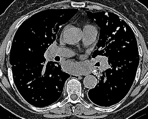 Case 182 Pulmonary Amyloidosis Radiology