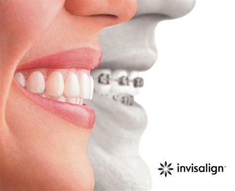 Top Invisalign Provider Invisalign Treatment Hyderabad