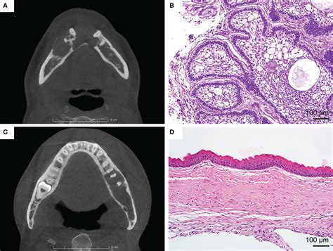 Odontogenic Keratocyst Radiology