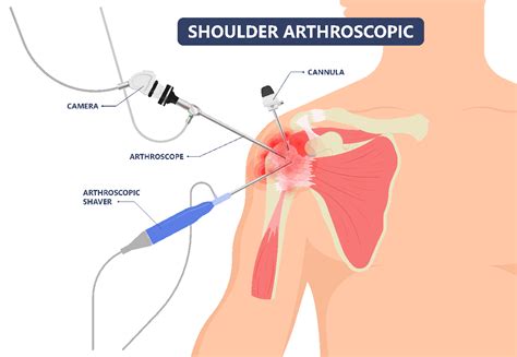 Shoulder Arthroscopy Columbus OH - Shoulder Pain Surgery