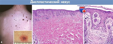 Как выглядит диспластический невус фото