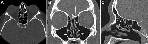 Imaging After Sinonasal Surgery Radiology Key