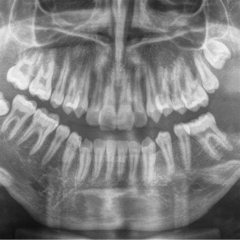 Panoramic Radiograph Reveals Destructive Lesion In The Left Posterior