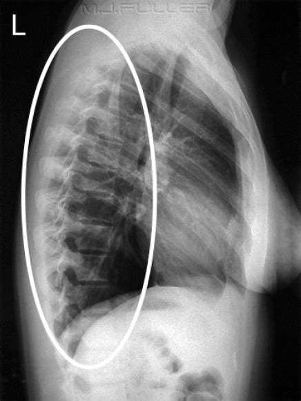 Interpreting A Chest X Ray Stepwards