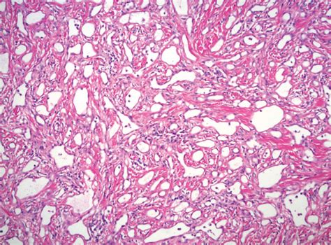 Adenomatoid Tumor Of The Testis Arising From The Tunica Albuginea