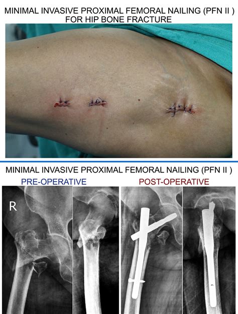 Minimally Invasive Fracture Surgery, hip fracture surgery Krishna Nagar ...