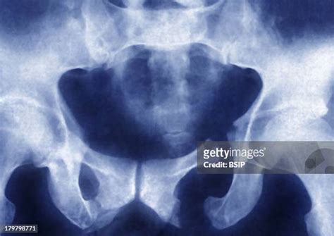 Pelvic Fractures Photos And Premium High Res Pictures Getty Images