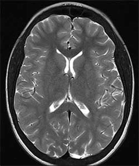 T1 T2 And PD Weighted Imaging Radiology Cafe