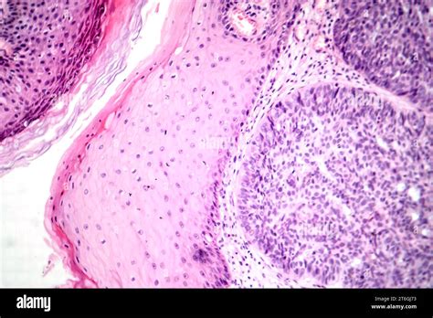 Photomicrograph Of Basal Cell Carcinoma Displaying Malignant Basal Cells Typical Of The Most