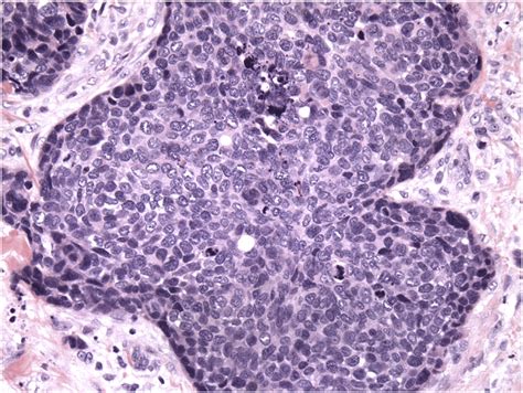 Metastatic Squamous Cell Carcinoma Involving Inguinal Lymph Node Hande Download Scientific