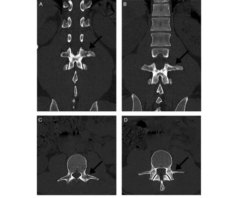 Isolated Thoracic And Lumbar Transverse Process Fractures 56 Off