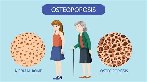 Free Vector | Bone Density and Osteoporosis Vector