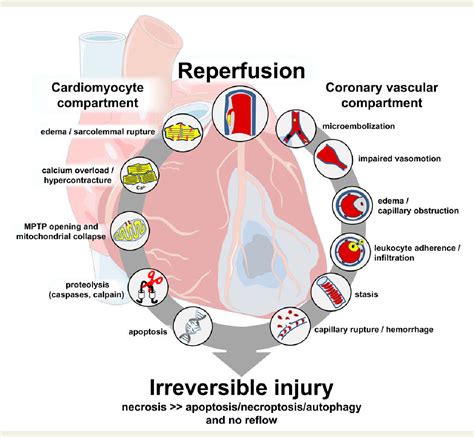 Pdf Pathophysiology Of Myocardial Infarction And Acute Management Hot Sex Picture