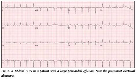 Ecg Pericardial Effusion