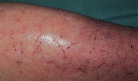 Dermatitis en las piernas por mala circulación cómo detectarla