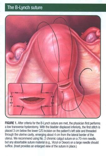 Postpartum Hemorrhage Flashcards Quizlet