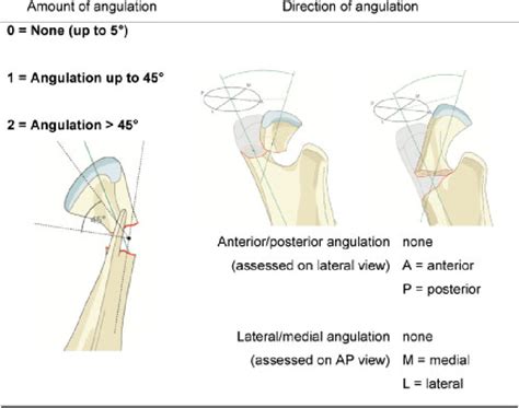 Angulation Of Superior Main Fragment At Neck Or Base Fracture Site Download Scientific Diagram