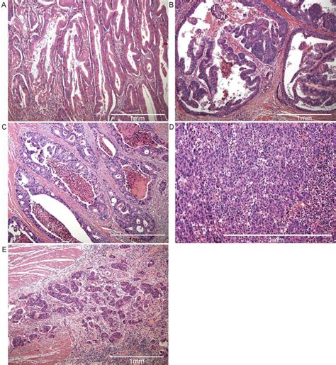 Histology And Its Prognostic Effect On Kras‑mutated Colorectal