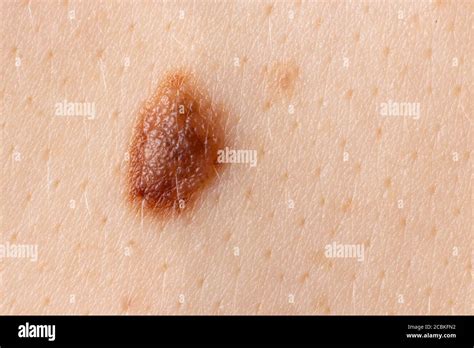 Mole Birthmark Nevus Macro Photo On Human Skin Close Up Stock Photo