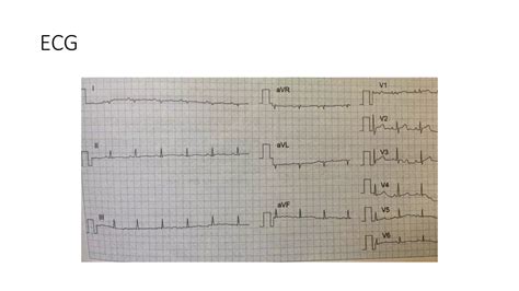 Chronic Constrictive Pericarditis Ideal Short Case Presentation PPT