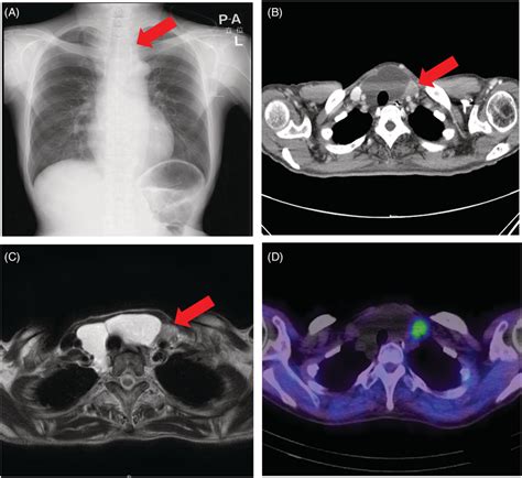 (a) Chest X‐ray showed no obvious abnormalities in the lung fields;... | Download Scientific Diagram