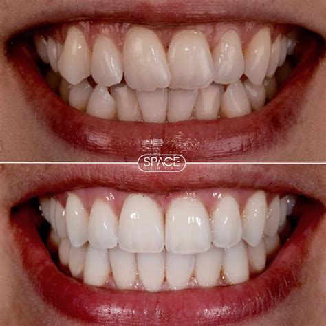 Invisalign Braces And Aligners Space Dental