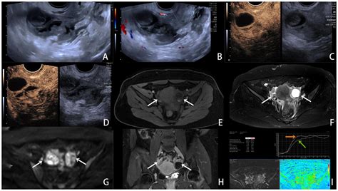 Comparative Study Of The Efficacy Of The Ovarian Adnexa Reporting And