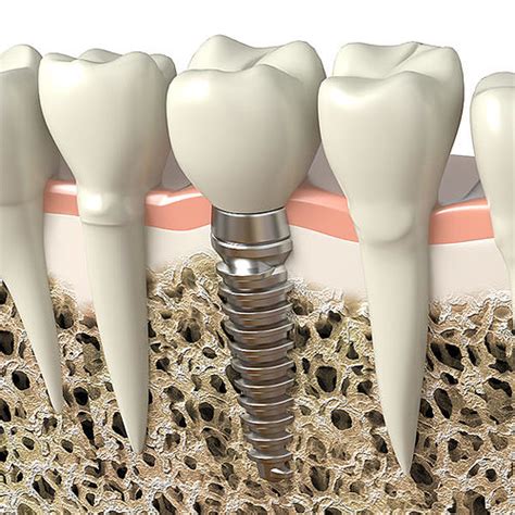 Dental Implant 3d Model Obj 3ds Fbx Blend